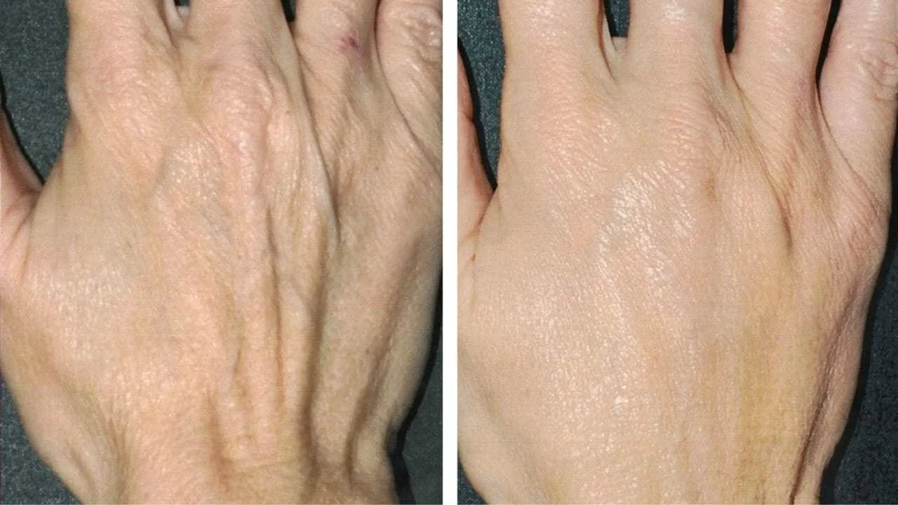 Rejuvenece Tus Manos A Os De Forma Natural Gracias A Este